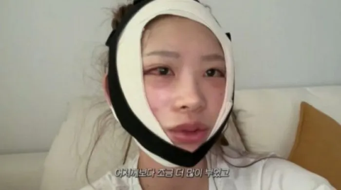 '故 최진실 딸' 최준희, 성형 브이로그 공개…후기 솔직 고백