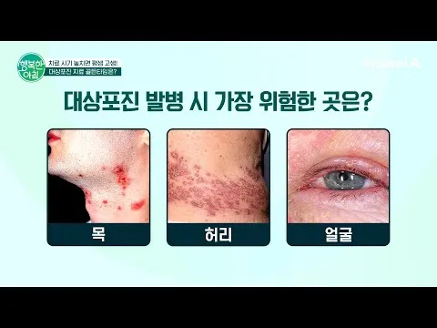 ภาวะแทรกซ้อนร้ายแรงของงูสวัดและสาเหตุที่พลาดโกลเดนไทม์