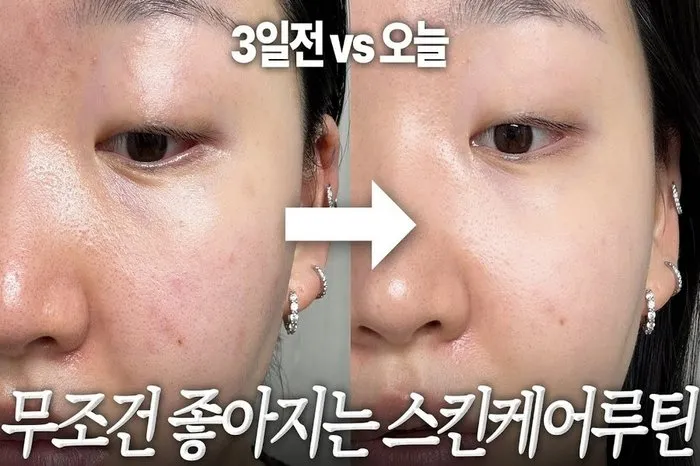 [K메이크업] 피부과 뺨치네…3일 만에 좋아지는 '급속 진정' 루틴